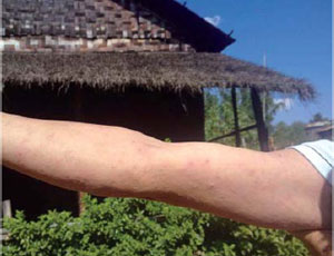 အရေပြားယားယံသည့်ဝေဒနာ ခံစားနေရသည့် လူတယောက်