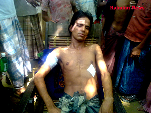 Ozi Ullah, the victim of local goons, is waiting for treatment refugeehit