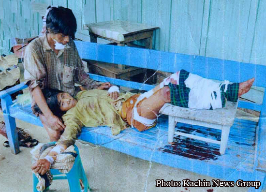 Wounded Lajaw Naw (left) and his wife Loilam Lu before the couple was hospitalized to Kamaing. Kachin_mine_victim