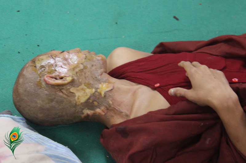 လုံခြံုရေးရဲများ အကြမ်းဖက် ဖြိုခွင်းမှုကြောင့် ထိခိုက်ဒဏ်ရာများမှာ မီးလောင် ဒဏ်ရာများသာ ဖြစ်ပြီး ဆီနှင့် အက်ဆစ်များ မပါဝင်ကြောင်း မုံရွာ ဆေးရုံအုပ်ကြီး ဒေါက်တာ သန်းထွဋ် က ပြော (ဓါတ်ပုံ ဟိန်းထက်/ မဇ္စျိမ) လုံခြံုရေးရဲများ အကြမ်းဖက် ဖြိုခွင်းမှုကြောင့် ထိခိုက်ဒဏ်ရာများမှာ မီးလောင် ဒဏ်ရာများသာ ဖြစ်ပြီး ဆီနှင့် အက်ဆစ်များ မပါဝင်ကြောင်း မုံရွာ ဆေးရုံအုပ်ကြီး ဒေါက်တာ သန်းထွဋ် က ပြော (ဓါတ်ပုံ ဟိန်းထက်/ မဇ္စျိမ)