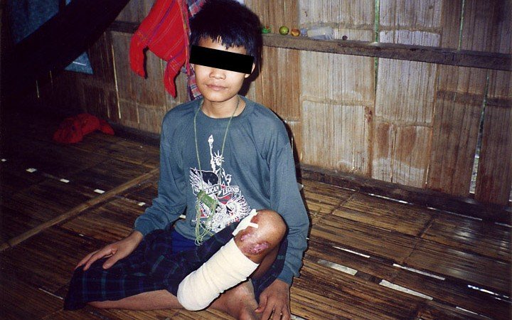 landmine-victim-from-shwegyin-town-in-nyaunglebin-district