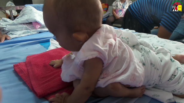 ကလေးလေးအား မခွဲစိပ်မီ ကလေးလေးအား မခွဲစိပ်မီ