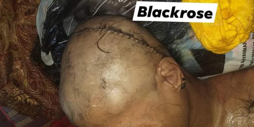 သေဆုံးသူ ဝင်းထွန်း၏ ရုပ်အလောင်း ဦးခေါင်းဒဏ်ရာ စစ်ဆေးခဲ့ပြီးတွေ့ရပုံ( Blackrose)