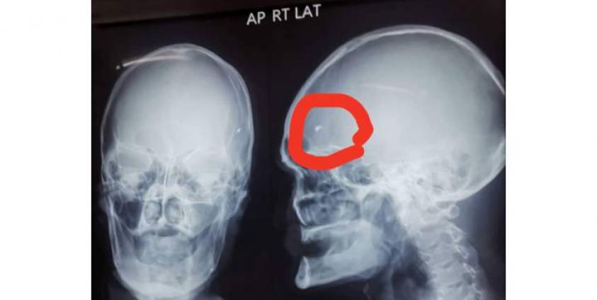 ဦးခေါင်းတွင်း ဒဏ်ရာရရှိ