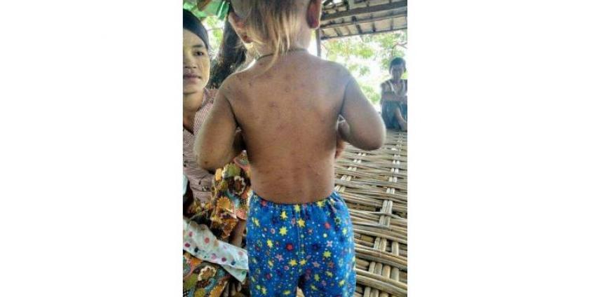 ပုံစာ - ရခိုင်ပြည်နယ် ကျောက်တော်မြို့စစ်ရှောင်စခန်းက ကလေးငယ်များသည်လည်း အရေပြားကူးစက်ရောဂါကို ၂၀၂၀ခုနှစ်မှာ ဖြစ်ပွားခဲ့ကြသည်။