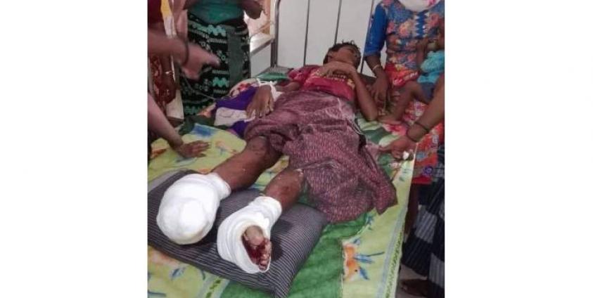 ဇူလိုင်လ ၈ ရက်နေ့က မြောက်ဦးမြို့နယ်၊  ပေါင်းတုတ်(ဘလောင်တော)ကျေးရွာမှ မိုင်းထိလူနာအား တွေ့ရစဉ်။ 