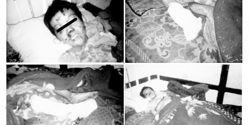 အောင်ပန်းဆေးရုံရောက်ဒဏ်ရာပြင်းထန်သည့် ကျေးသီး ငူးလိမ်ရွာမှ အသက် ၁၀ နှစ်အရွယ် စိုင်းလှိုင်းနွံ (photo/SNLD Kesi)