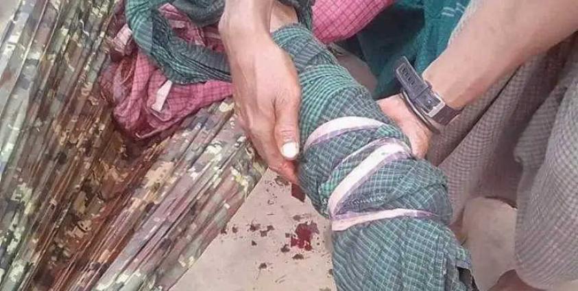 Nai Bai, who was injured by landmine blast, was taken to the hospital (MNA)