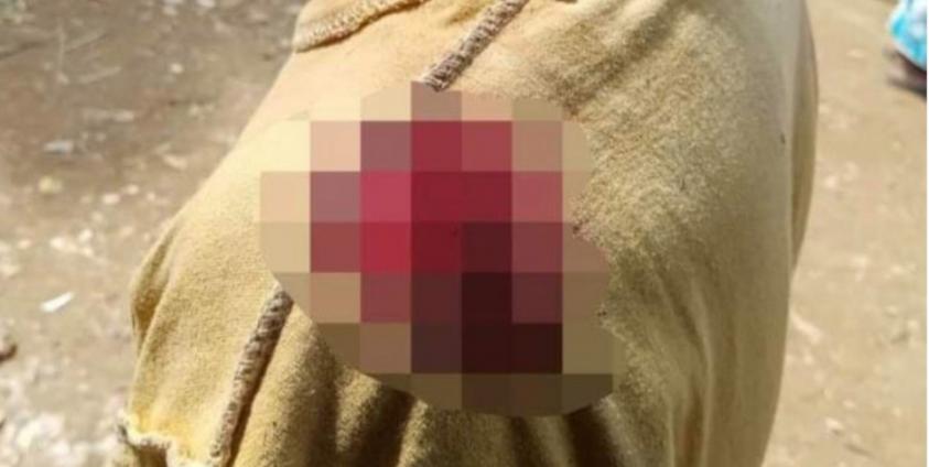 ဘူးသီးတောင်မြို့နယ်မှ လက်မောင်းတွင် ဒဏ်ရာရသူ တစ်ဦးကိုတွေ့ရစဉ်