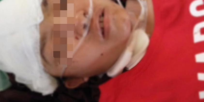 Photo form Tin Maung Thein Facebook/ ဒဏ်ရာပြင်းထန်သဖြင့် မန္တလေးဆေးရုံတွင် သေဆုံးသွားသော လွေးခမ်းယဉ်