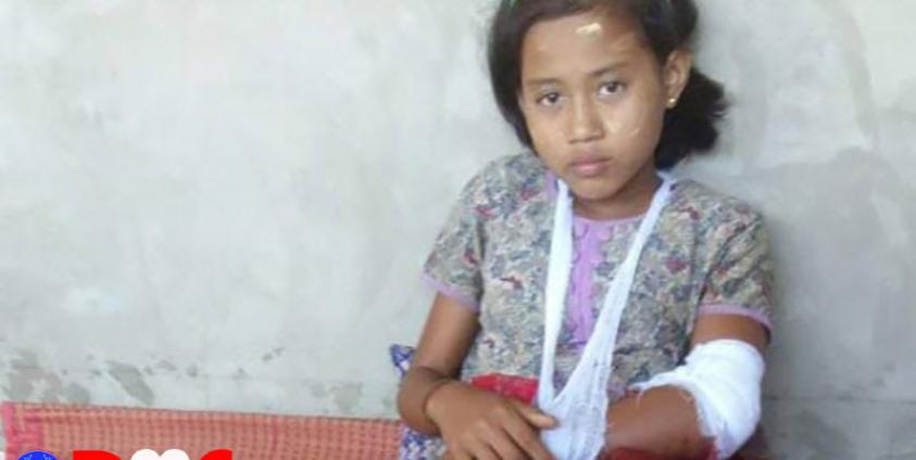 Ma Hnin Chay, 13 years old, got injured due to the fighting near her village. Photo_ Kyauk Yan Sayardaw