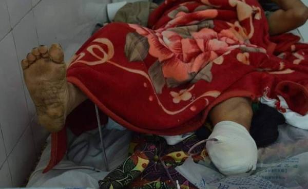 မိုင်းနင်းမိဒဏ်ရာရခဲ့သော ဒေသခံ