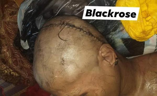 သေဆုံးသူ ဝင်းထွန်း၏ ရုပ်အလောင်း ဦးခေါင်းဒဏ်ရာ စစ်ဆေးခဲ့ပြီးတွေ့ရပုံ( Blackrose)