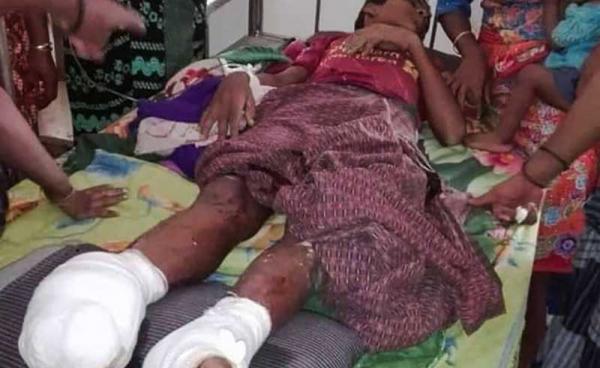 A young man was recently injured in a landmine blast near Paungtoke village in Mrauk-U Township. Photo: ARE