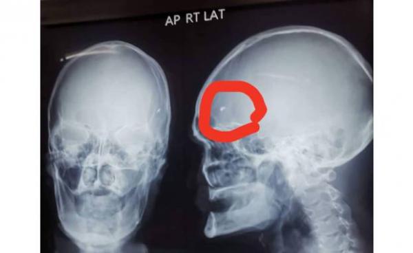 ဦးခေါင်းတွင်း ဒဏ်ရာရရှိ