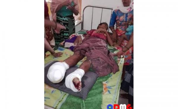 ဇူလိုင်လ ၈ ရက်နေ့က မြောက်ဦးမြို့နယ်၊  ပေါင်းတုတ်(ဘလောင်တော)ကျေးရွာမှ မိုင်းထိလူနာအား တွေ့ရစဉ်။ 