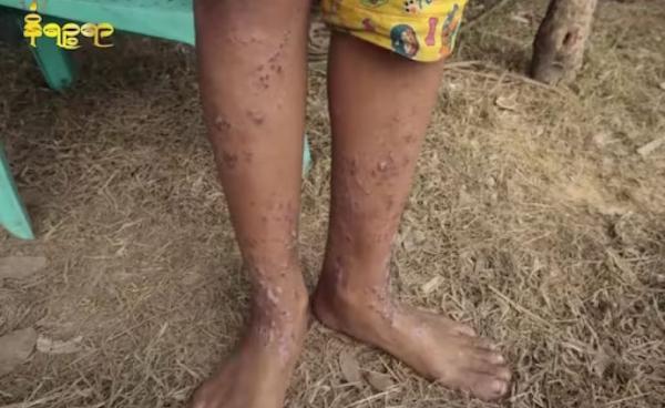 လက်ရှိ စစ်ဘေးရှောင်စခန်းများတွင် အရေပြားရောဂါဖြစ်ပွားနေသူများအား တွေ့ရစဥ်။