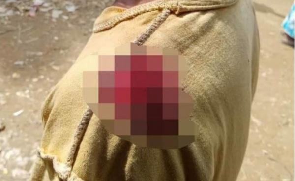 ဘူးသီးတောင်မြို့နယ်မှ လက်မောင်းတွင် ဒဏ်ရာရသူ တစ်ဦးကိုတွေ့ရစဉ်