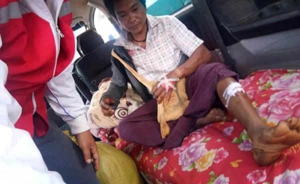 Photo by Tin Maung Thein/ ယမန်နေ့ တောင်ပလို့ ရွာသား မြေမြုပ်မိုင်း နင်းမိကာ ထိခိုက်ဒဏ်ရာရပုံ