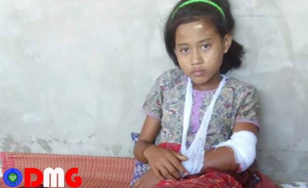 Ma Hnin Chay, 13 years old, got injured due to the fighting near her village. Photo_ Kyauk Yan Sayardaw